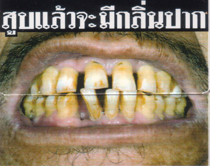 Rauchen ist böse. Und Thailand ist das wohl konsequenteste Land in der Bekämpfung der Raucher ;) Auf den Zigarettenschachteln stehen nicht die in Europa beliebten Schwarzen Sätze sondern gleich unterhaltsame Bilder, was alles so passieren kann, wenn man raucht.
Heute mein persönlicher Favorit: Vermutlich soll das Gebiss von Verfärbungen durch Nikotin sprechen. Wenn man allerdings bedenkt, dass Teethwhitening hier relativ preiswert zu bekommen ist (ich werde berichten), dann greift das Argument leider nicht.
Wenn man übrigens die Klappenposition der Schachtel betrachtet, kann man sich schon denken, welchen Spass man mit einer in das Klappengebiss gesteckten Zigarette haben kann. Wirklich preiswerte Unterhaltung.